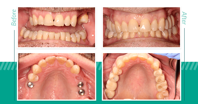 Crown Placement & Final Restoration