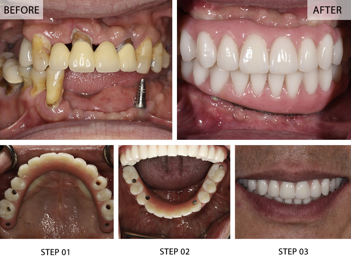 Fixed Dental Bridge