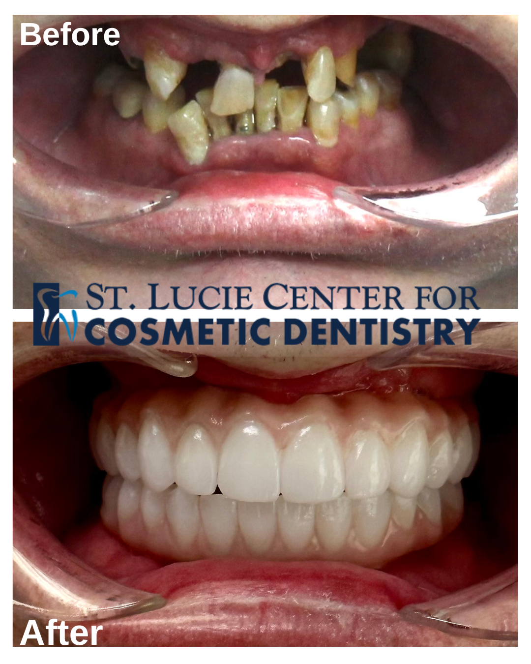 Complete Dentures