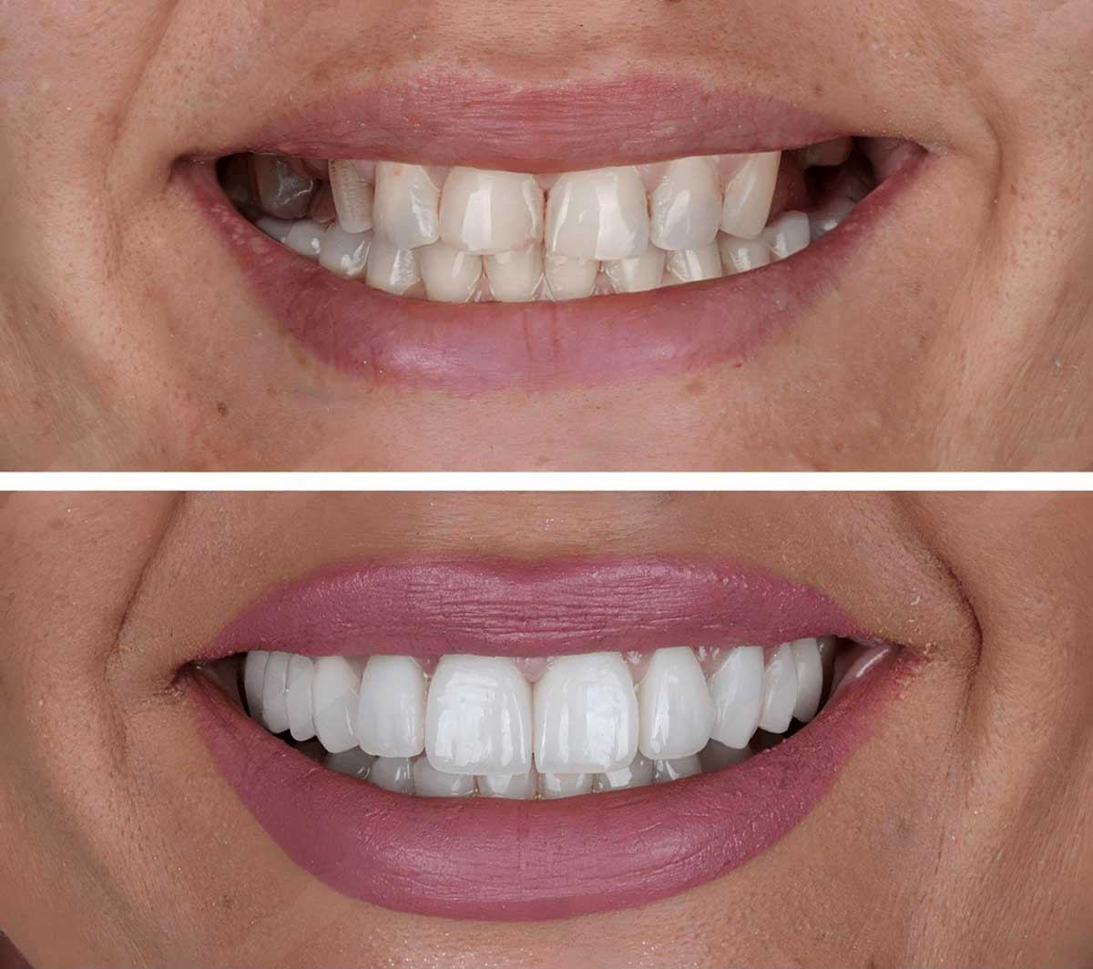 Removable Partial Dentures