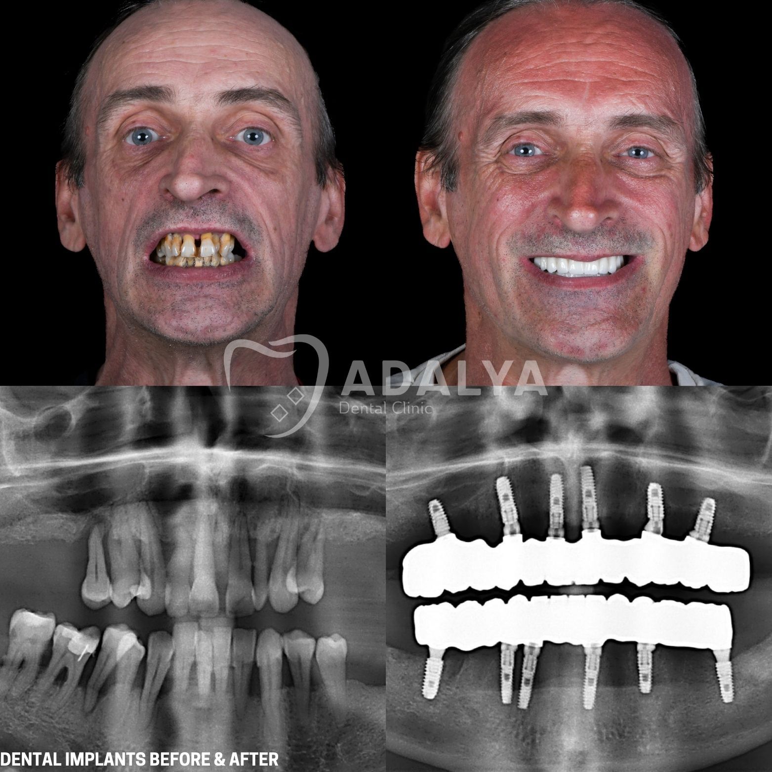 Implant-Supported Dentures