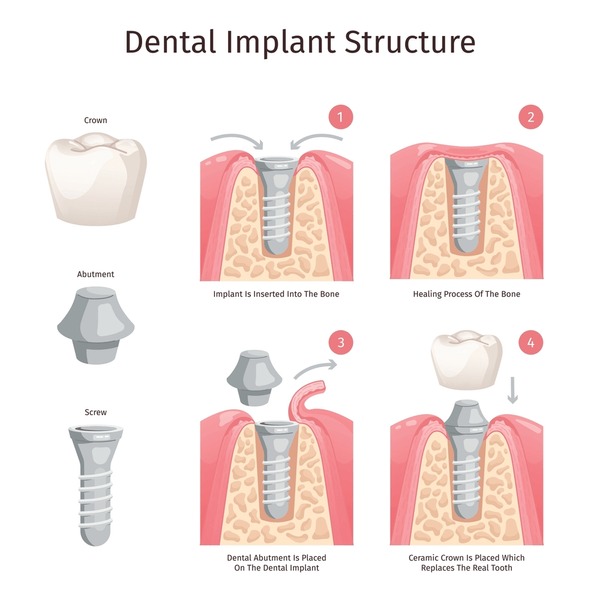 Daily dental implant care routine