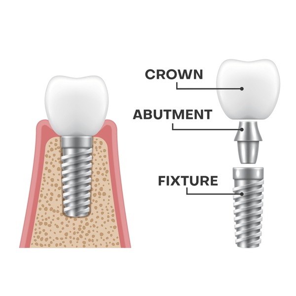 Implant Placement Surgery