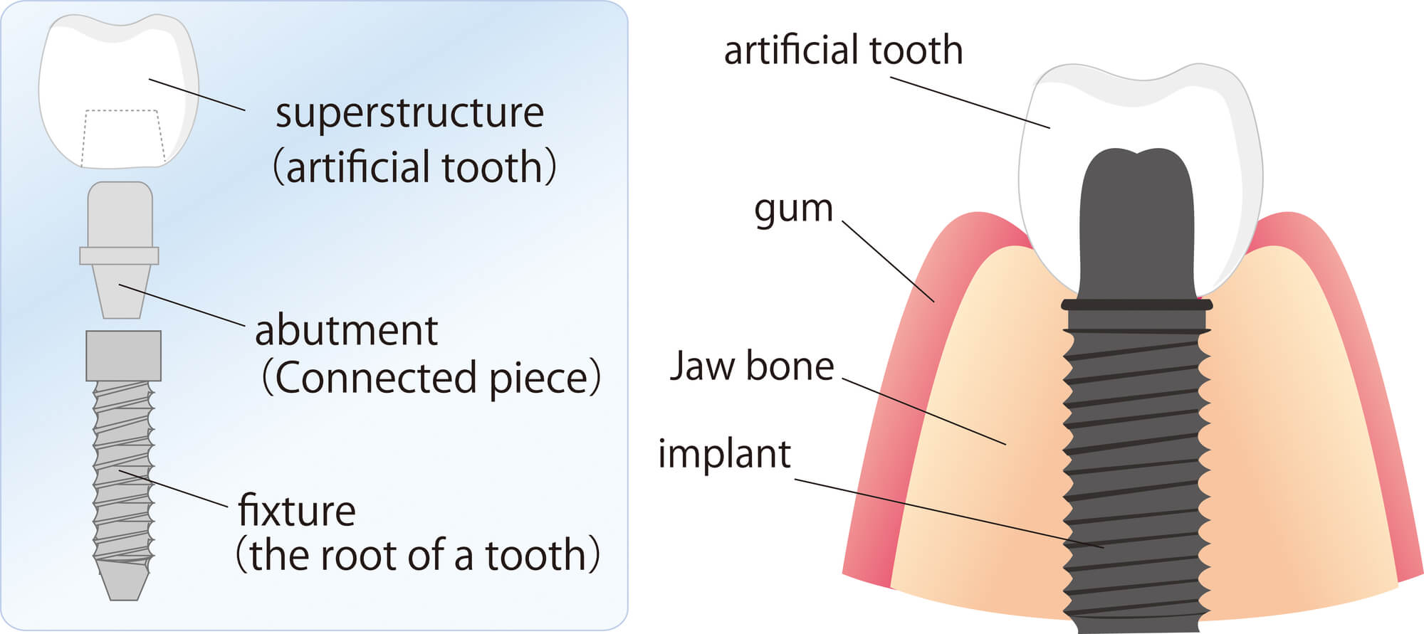 Long-term implant maintenance