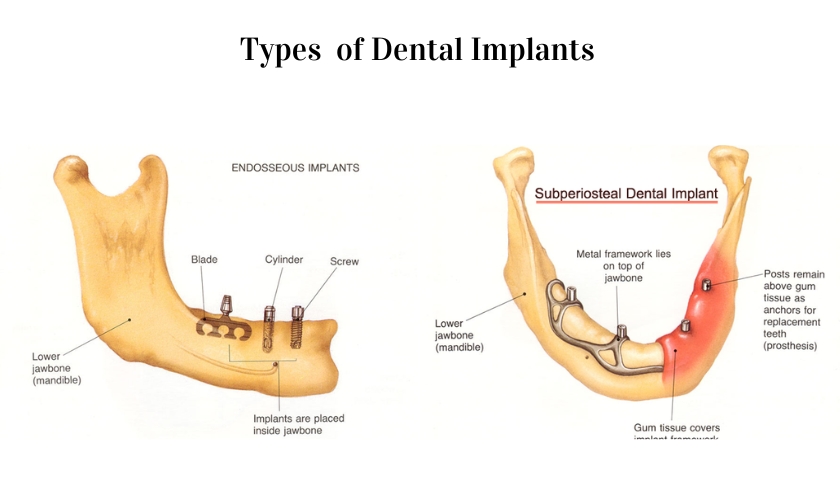 Multiple Teeth Implants