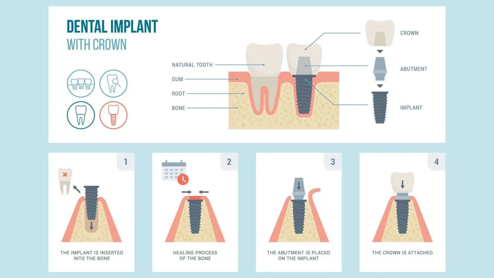 Healing & Osseointegration